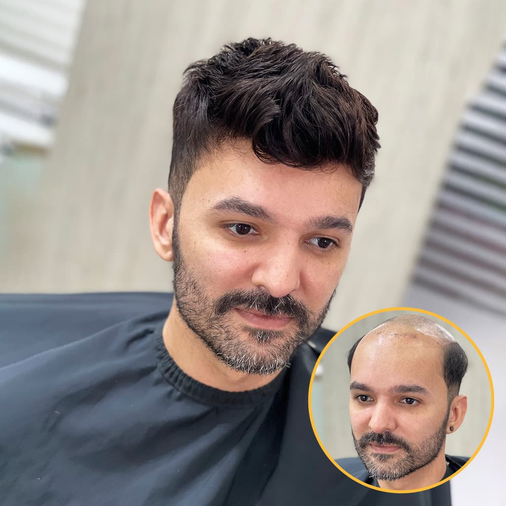 HS7F Full Lace Hair System With Realistic Hairline and Parts Wholesale thumbnail 6